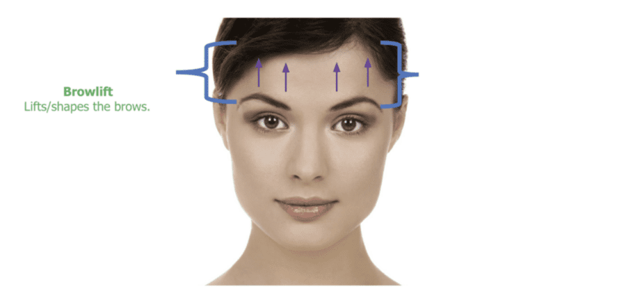 Brow lift infographic