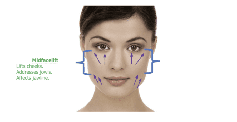 Mid facelift infographic