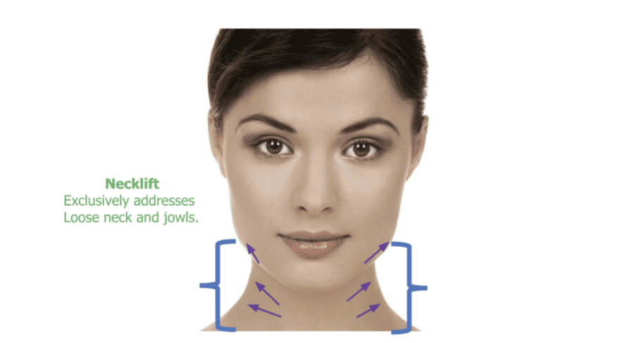 Neck lift infographic