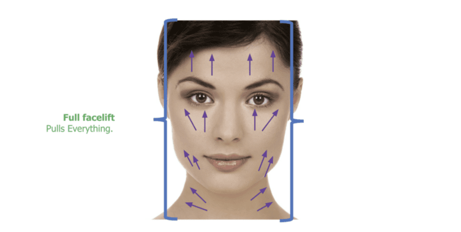 Full facelift infographic