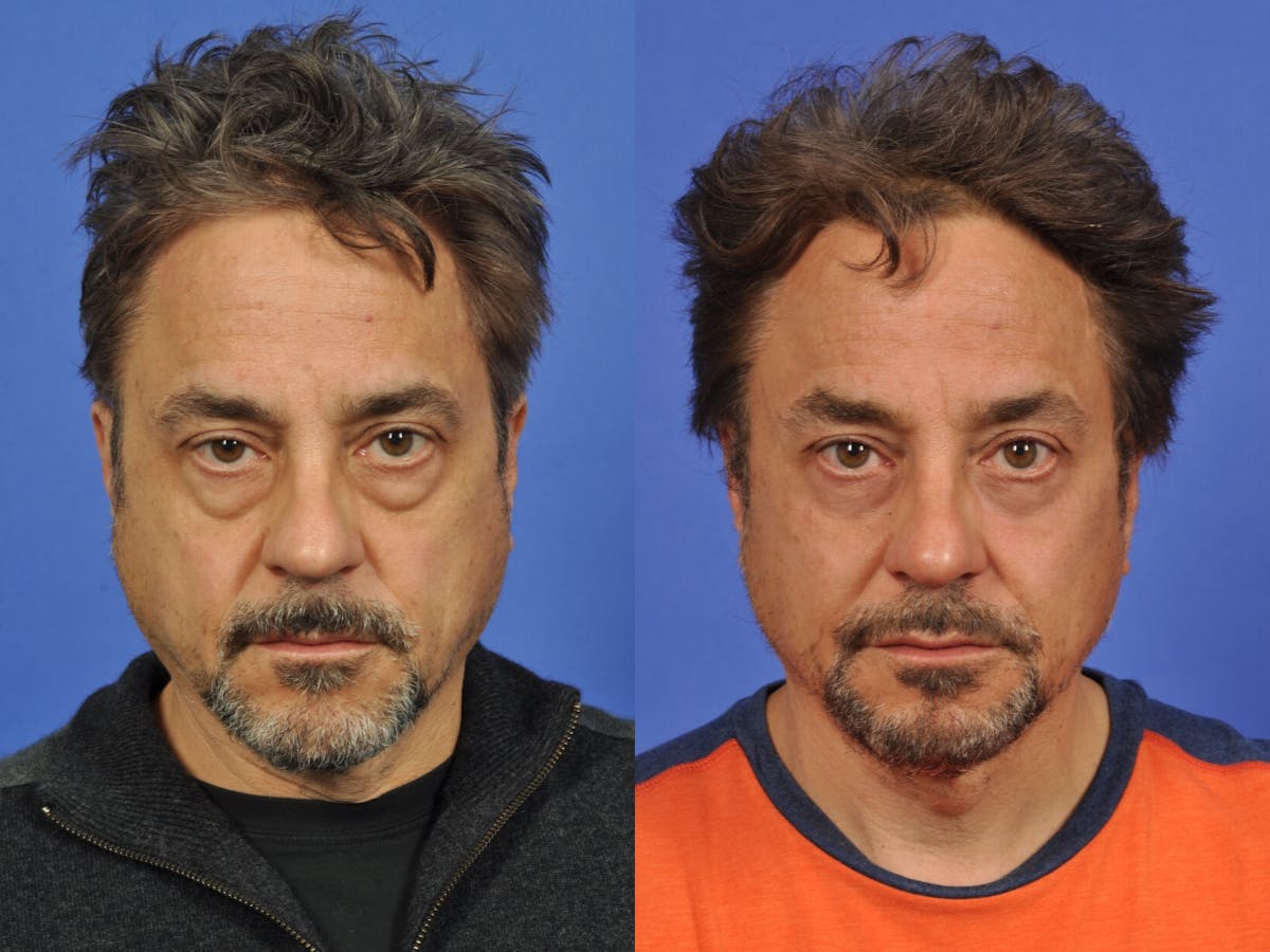 Blepharoplasty Before & After Gallery - Patient 275106 - Image 1