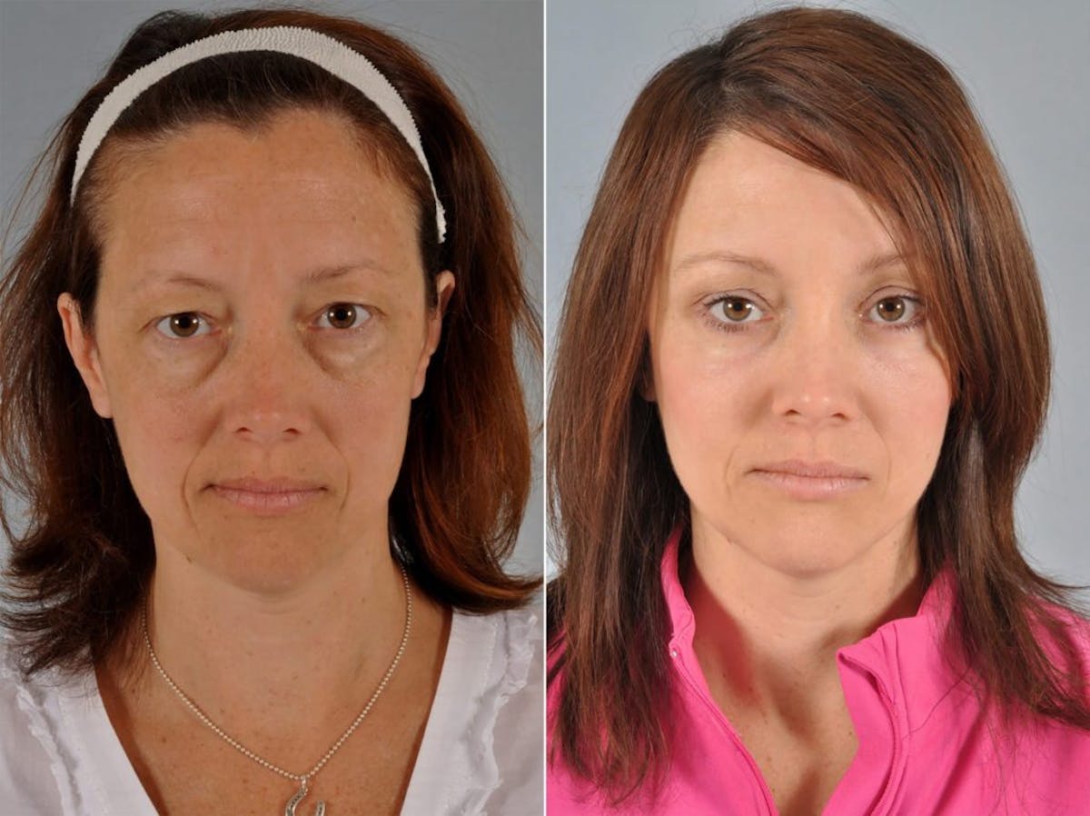Blepharoplasty Before & After Gallery - Patient 216405 - Image 1