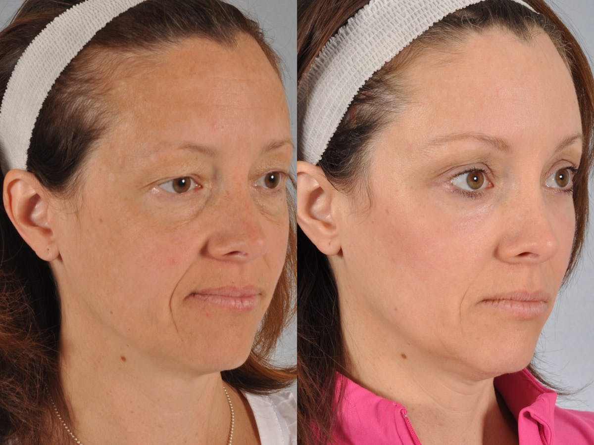 Blepharoplasty Before & After Gallery - Patient 216405 - Image 3