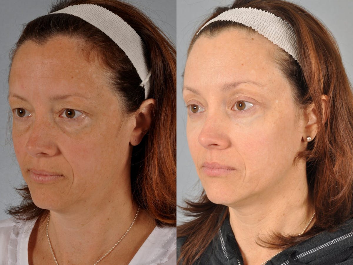 Blepharoplasty Before & After Gallery - Patient 216405 - Image 4