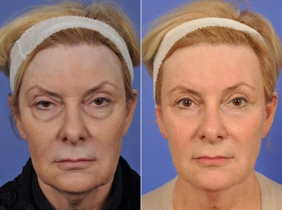 Blepharoplasty Before & After Gallery - Patient 243204 - Image 1