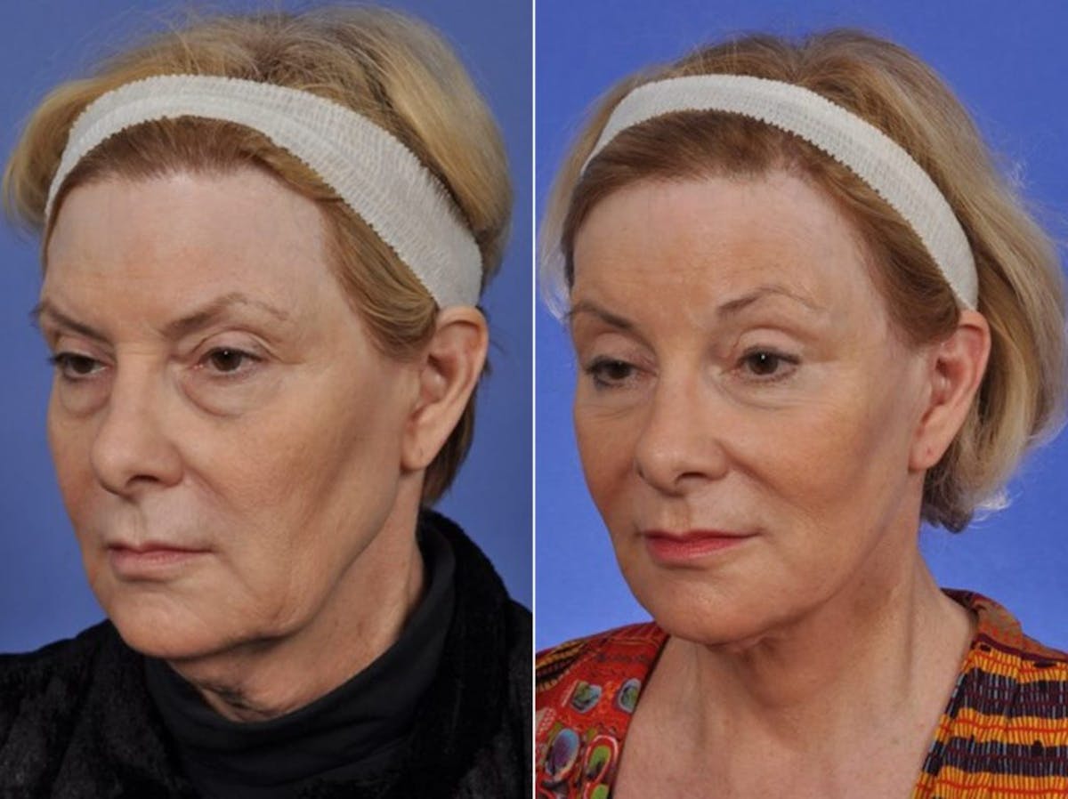 Blepharoplasty Before & After Gallery - Patient 243204 - Image 2