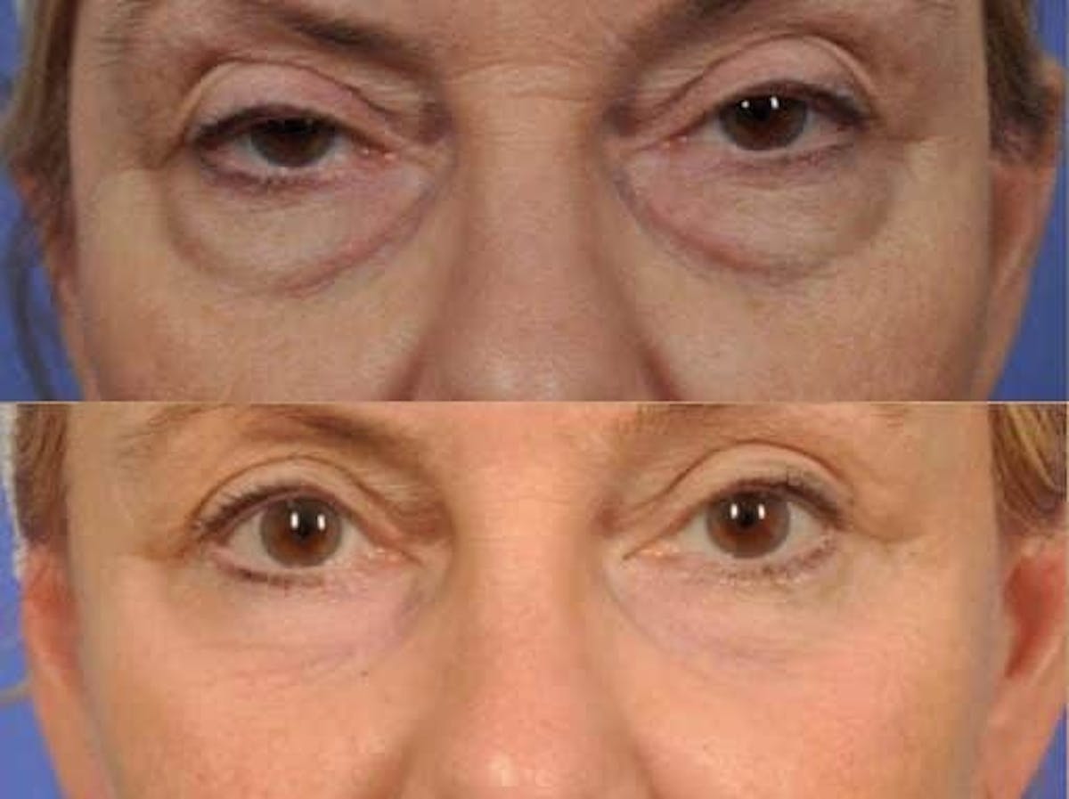Blepharoplasty Before & After Gallery - Patient 243204 - Image 3