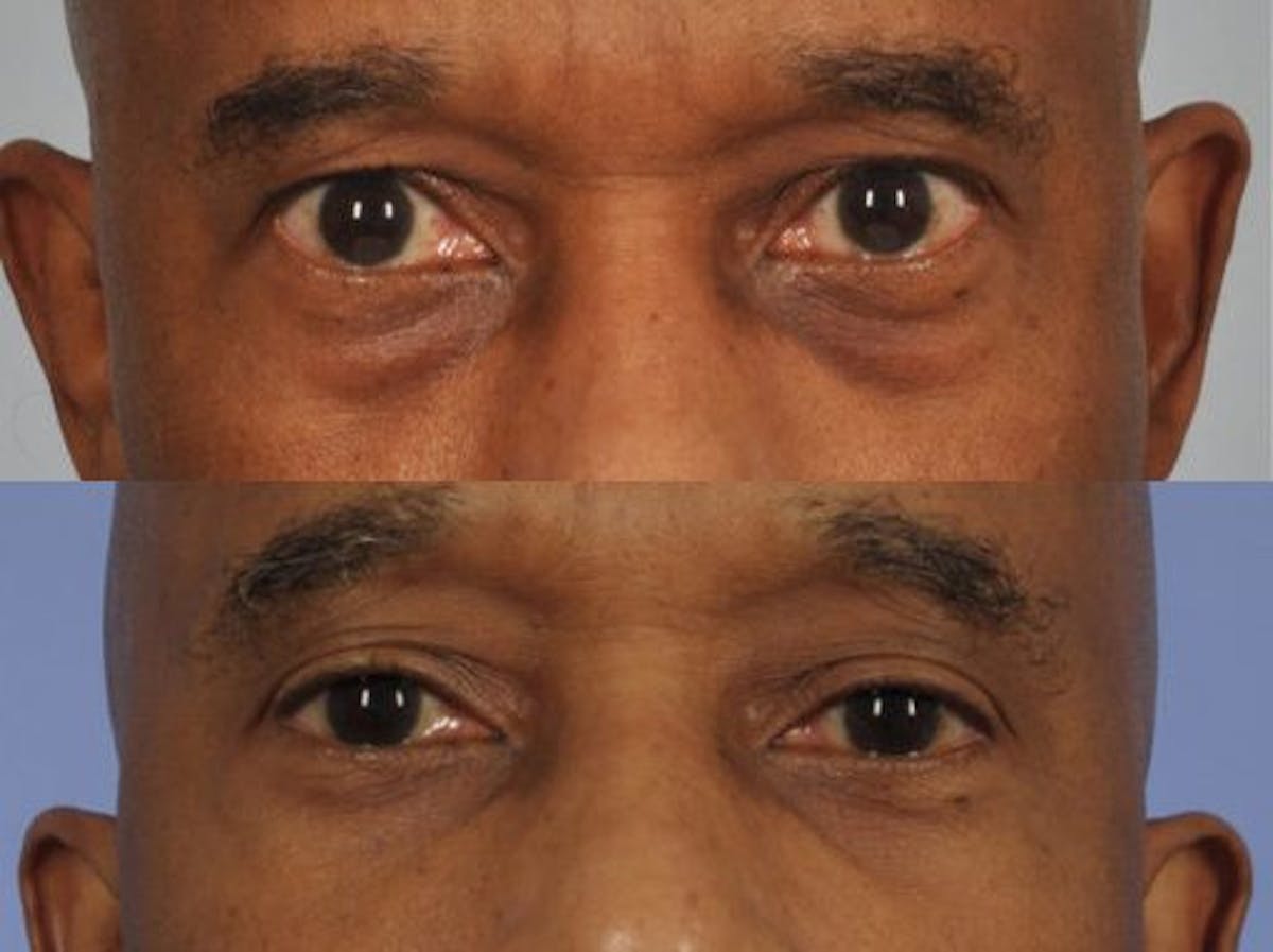 Blepharoplasty Before & After Gallery - Patient 260618 - Image 1