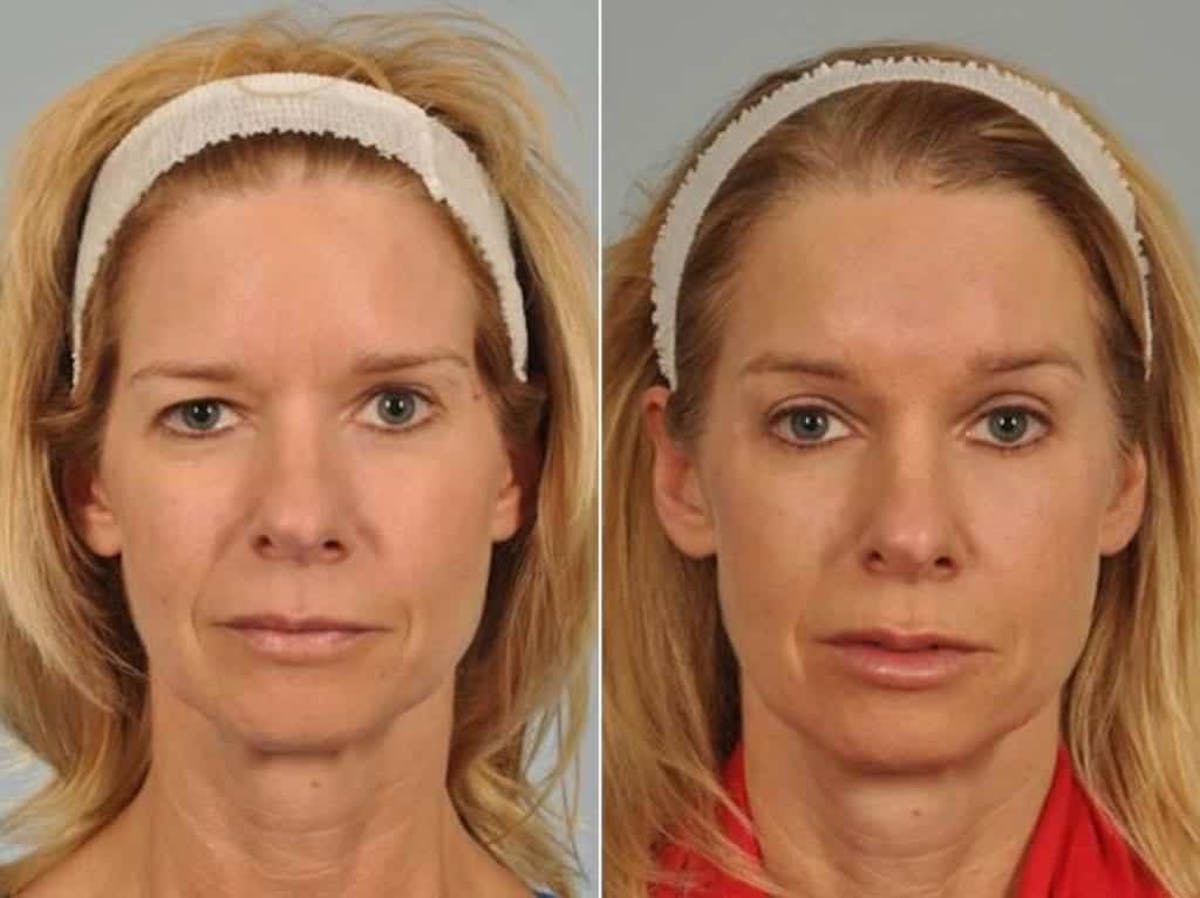 Blepharoplasty Before & After Gallery - Patient 502638 - Image 1