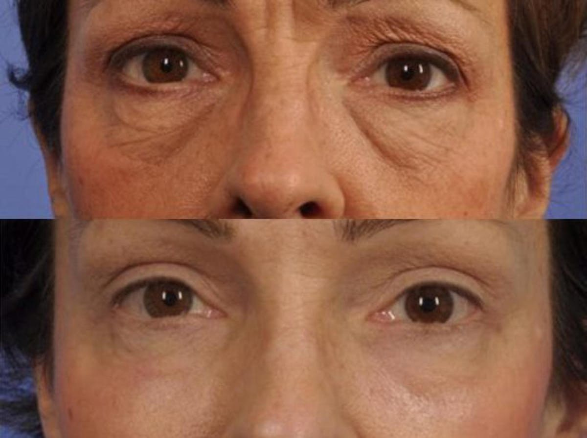 Blepharoplasty Before & After Gallery - Patient 131661 - Image 1