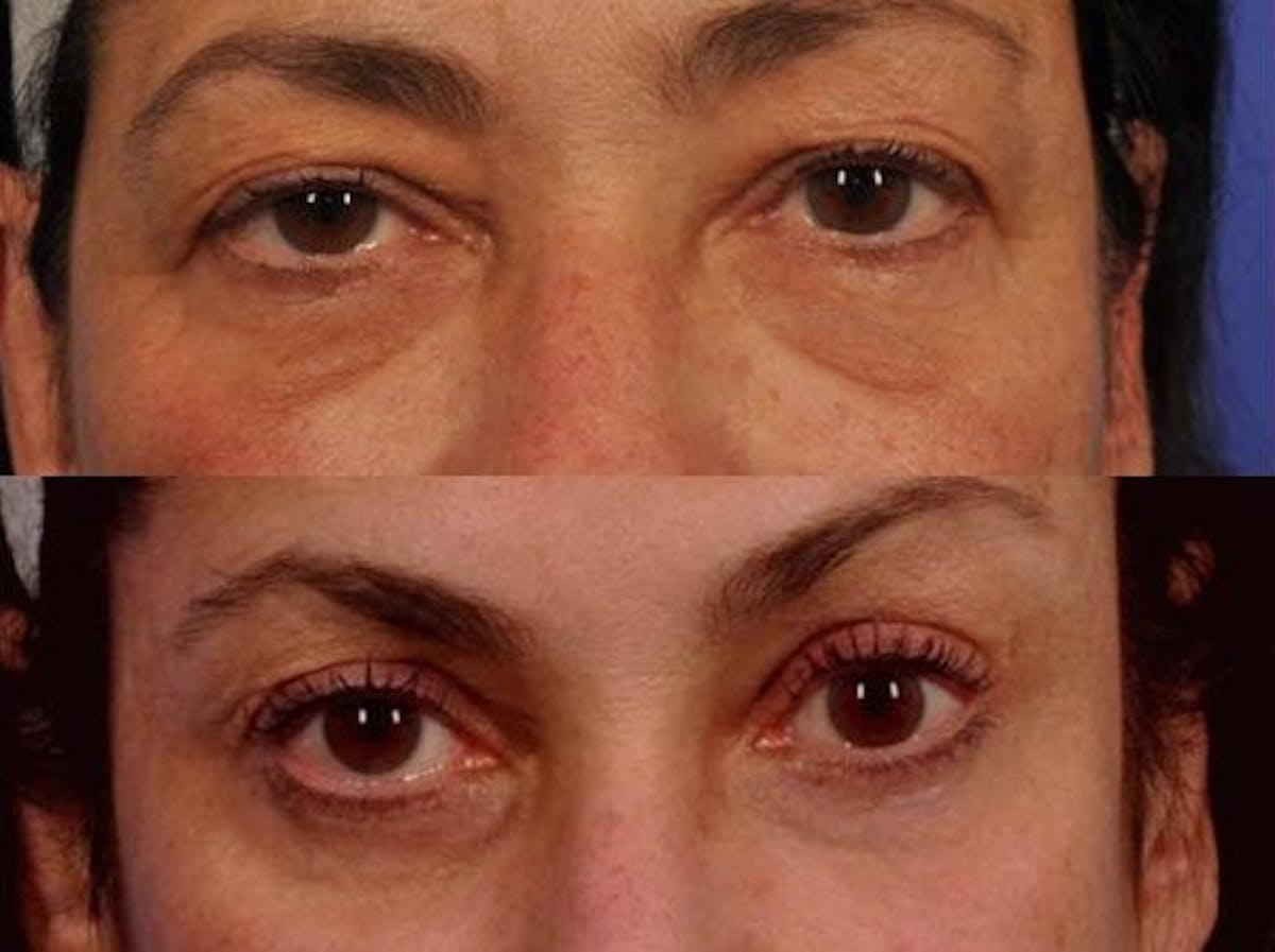 Blepharoplasty Before & After Gallery - Patient 339773 - Image 1