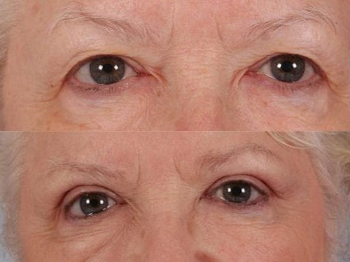 Blepharoplasty Before & After Gallery - Patient 366788 - Image 1
