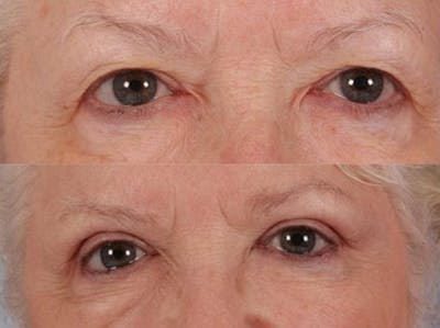 Blepharoplasty Before & After Gallery - Patient 366788 - Image 1