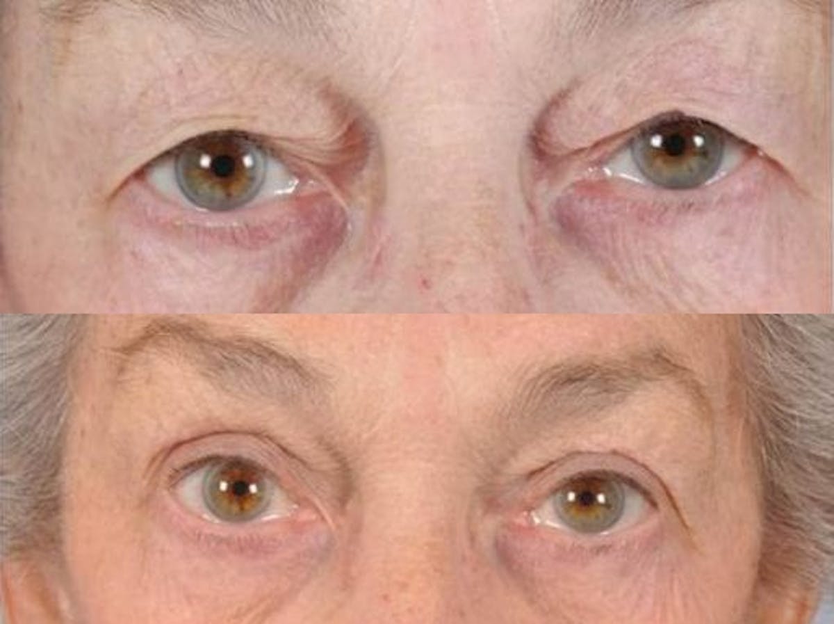 Blepharoplasty Before & After Gallery - Patient 270301 - Image 1