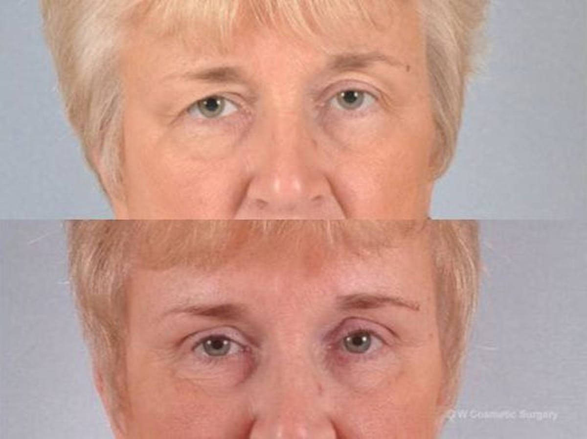 Blepharoplasty Before & After Gallery - Patient 221122 - Image 1