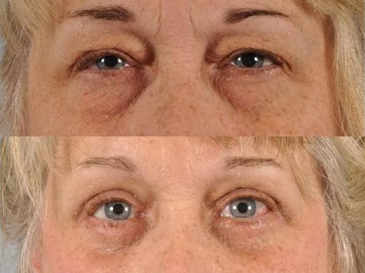 Blepharoplasty Before & After Gallery - Patient 111973 - Image 1