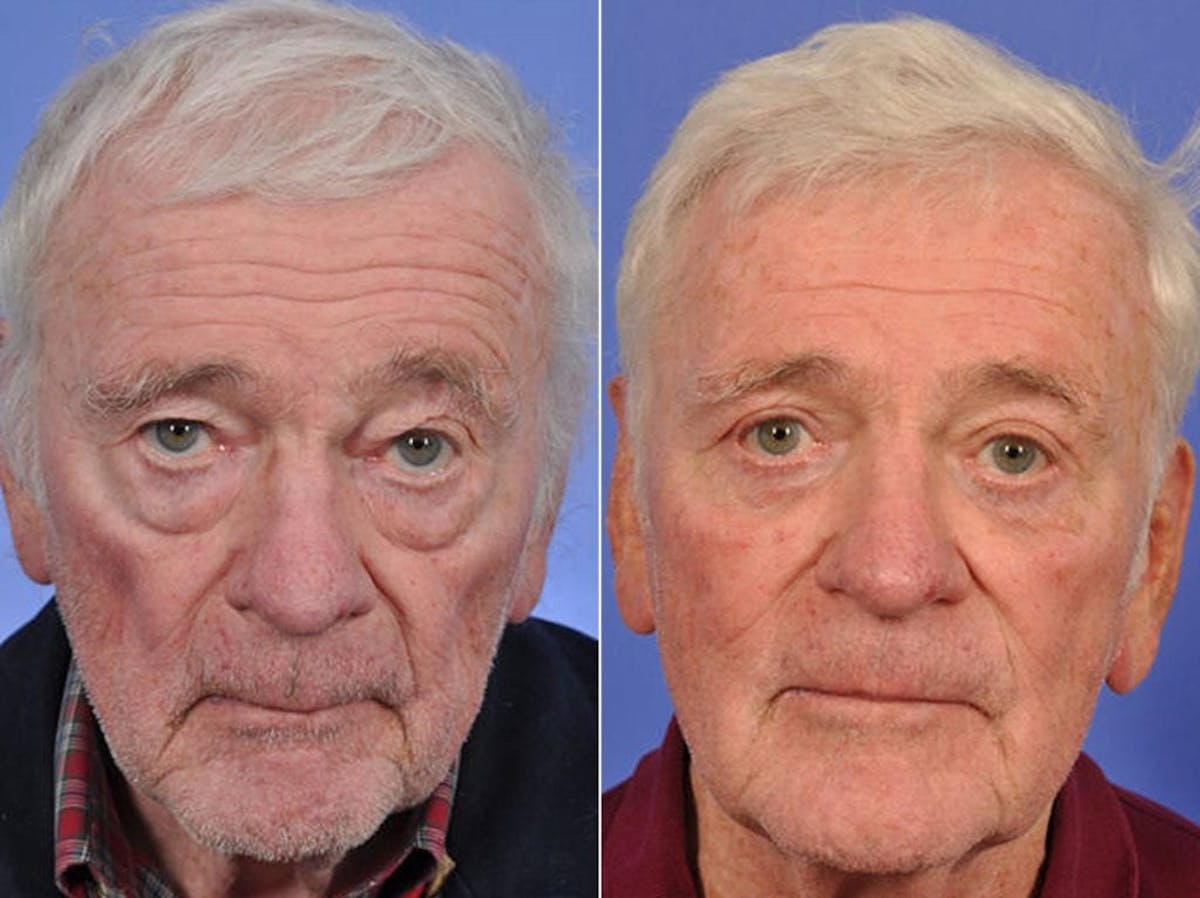 Blepharoplasty Before & After Gallery - Patient 414777 - Image 1