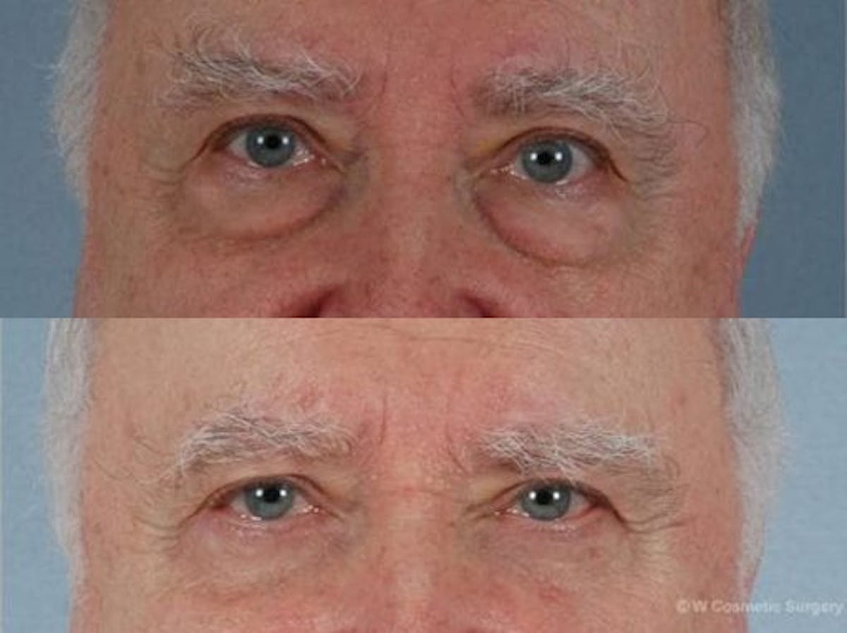 Blepharoplasty Before & After Gallery - Patient 161520 - Image 1