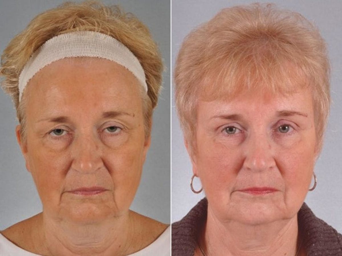 Blepharoplasty Before & After Gallery - Patient 126331 - Image 1