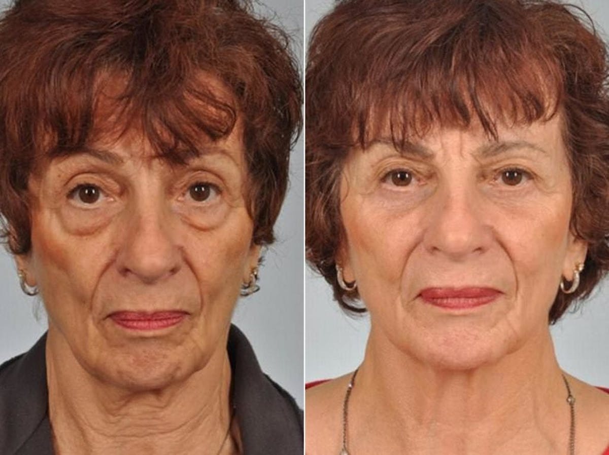 Blepharoplasty Before & After Gallery - Patient 135358 - Image 1
