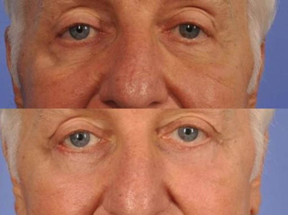 Blepharoplasty Before & After Gallery - Patient 392608 - Image 1