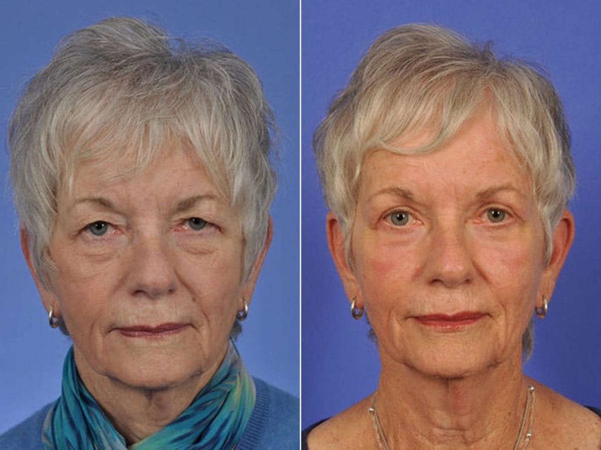 Blepharoplasty Before & After Gallery - Patient 231561 - Image 1