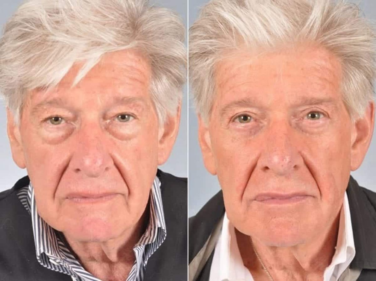 Blepharoplasty Before & After Gallery - Patient 226514 - Image 1