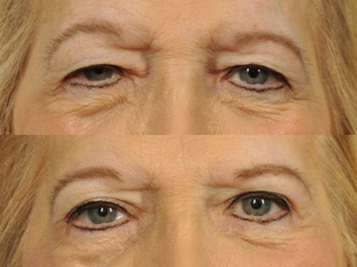 Blepharoplasty Before & After Gallery - Patient 345165 - Image 1