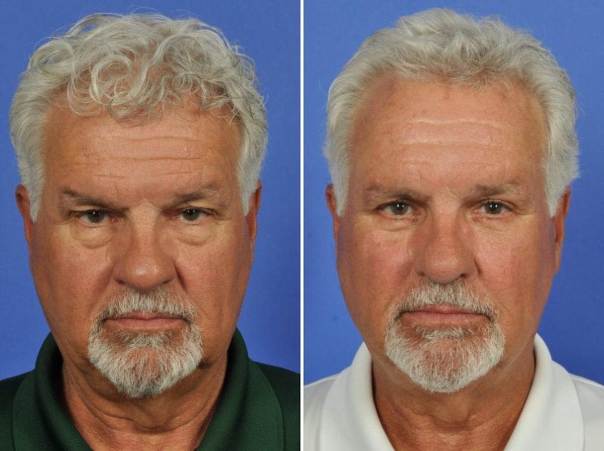 Blepharoplasty Before & After Gallery - Patient 171080 - Image 1
