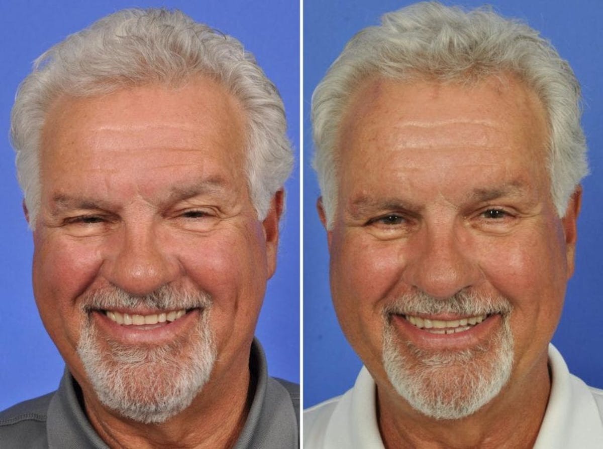 Blepharoplasty Before & After Gallery - Patient 171080 - Image 2