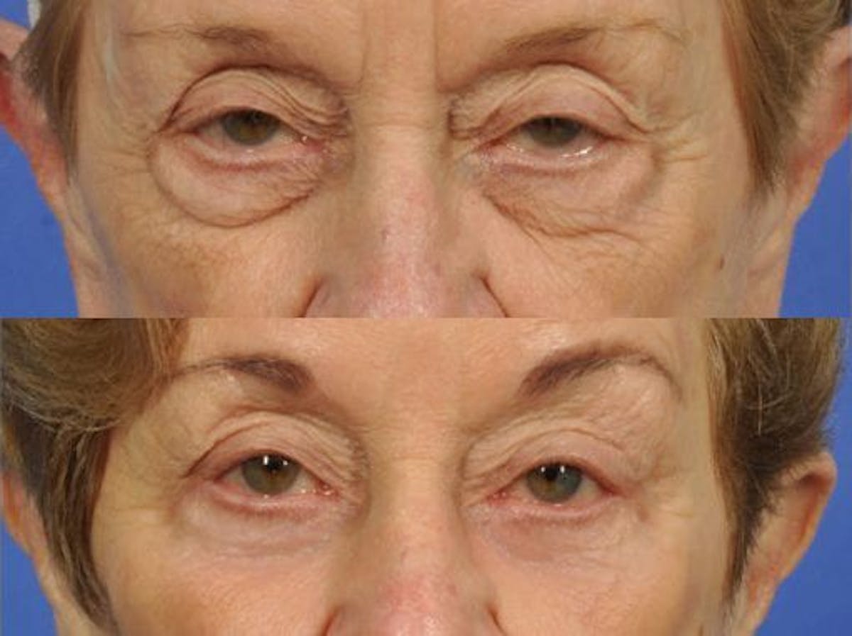 Blepharoplasty Before & After Gallery - Patient 153454 - Image 1
