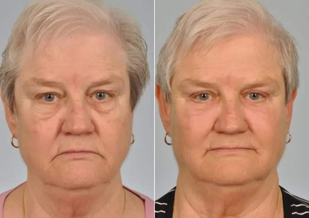 Blepharoplasty Before & After Gallery - Patient 246192 - Image 1