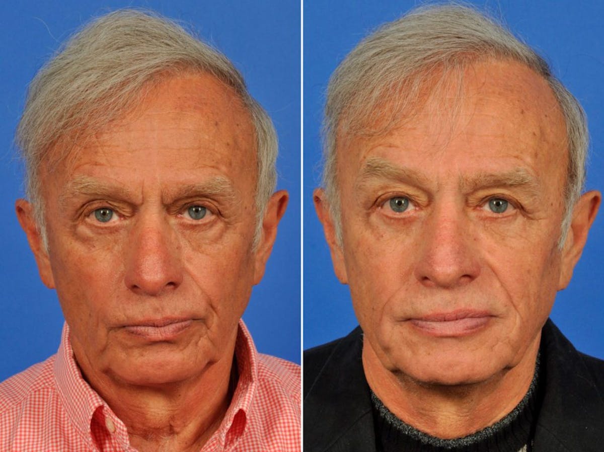 Blepharoplasty Before & After Gallery - Patient 127869 - Image 1
