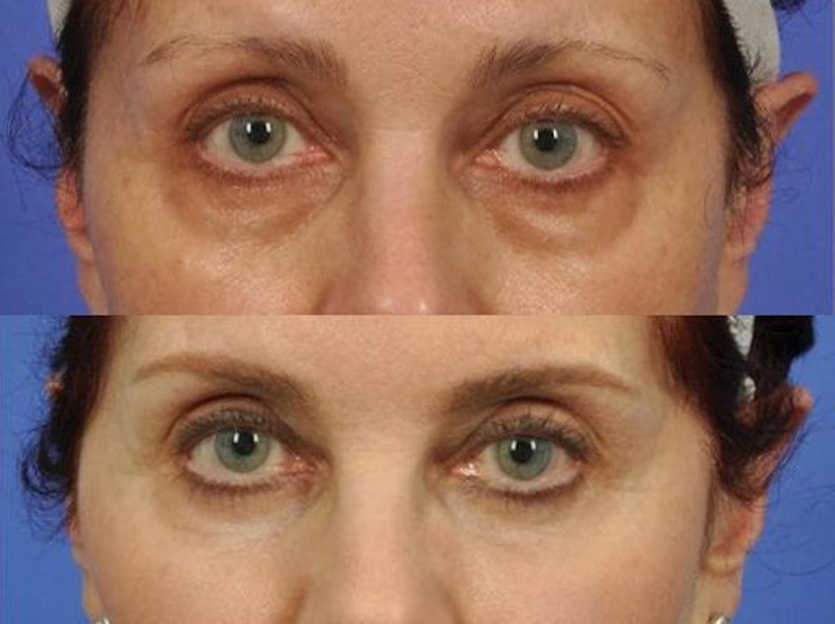 Blepharoplasty Before & After Gallery - Patient 335218 - Image 1