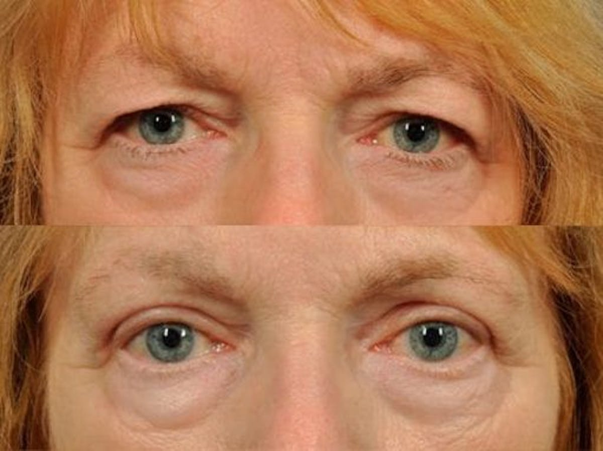 Blepharoplasty Before & After Gallery - Patient 374325 - Image 1