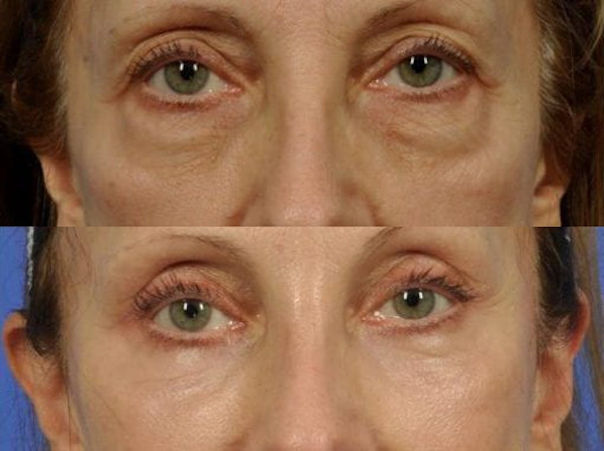 Blepharoplasty Before & After Gallery - Patient 229758 - Image 1