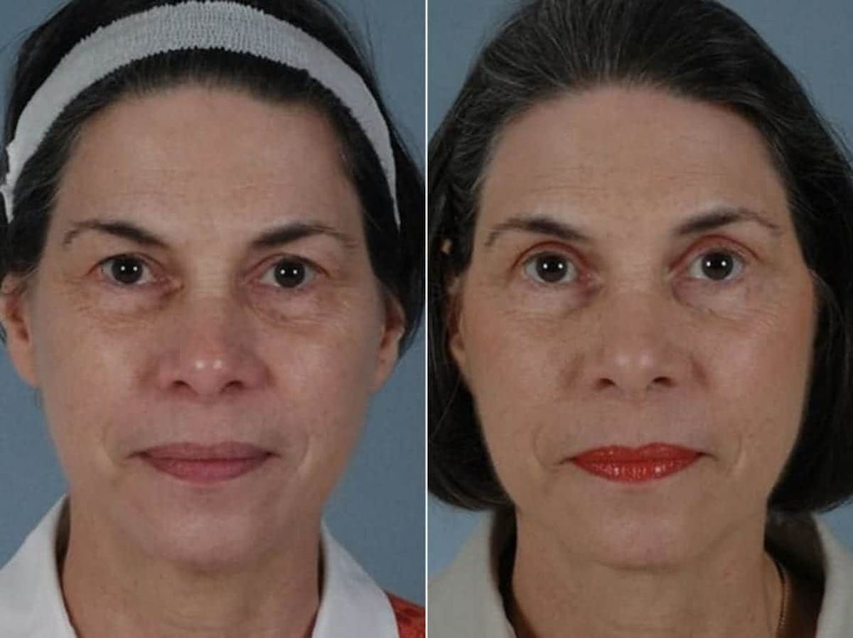 Blepharoplasty Before & After Gallery - Patient 241712 - Image 1