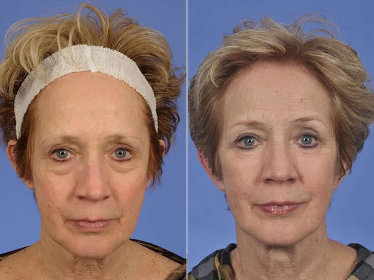 Blepharoplasty Before & After Gallery - Patient 352730 - Image 1