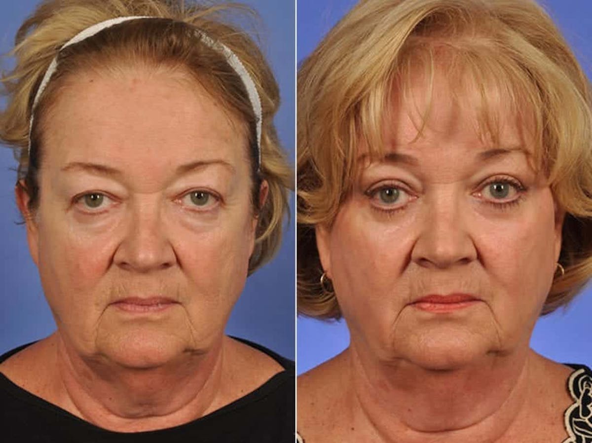Blepharoplasty Before & After Gallery - Patient 397958 - Image 1