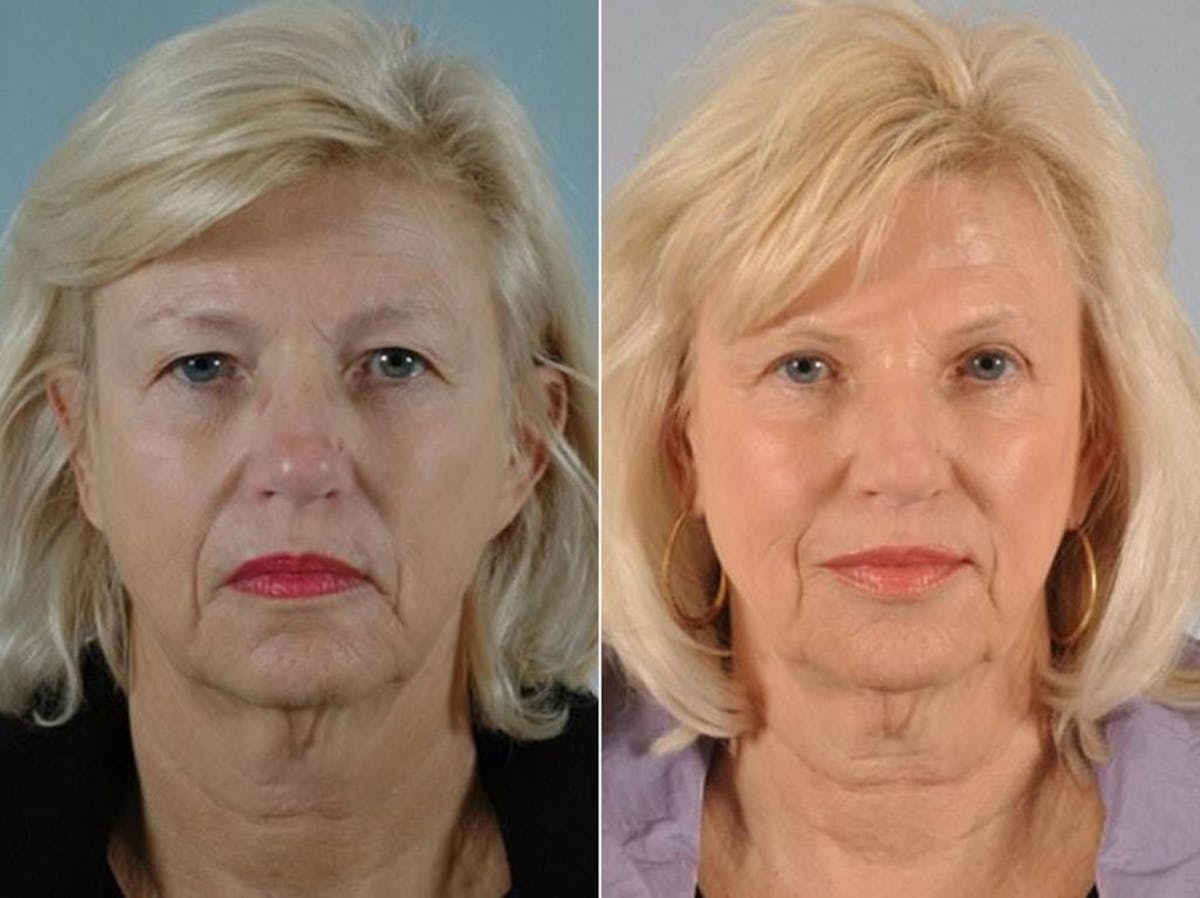 Blepharoplasty Before & After Gallery - Patient 171375 - Image 1