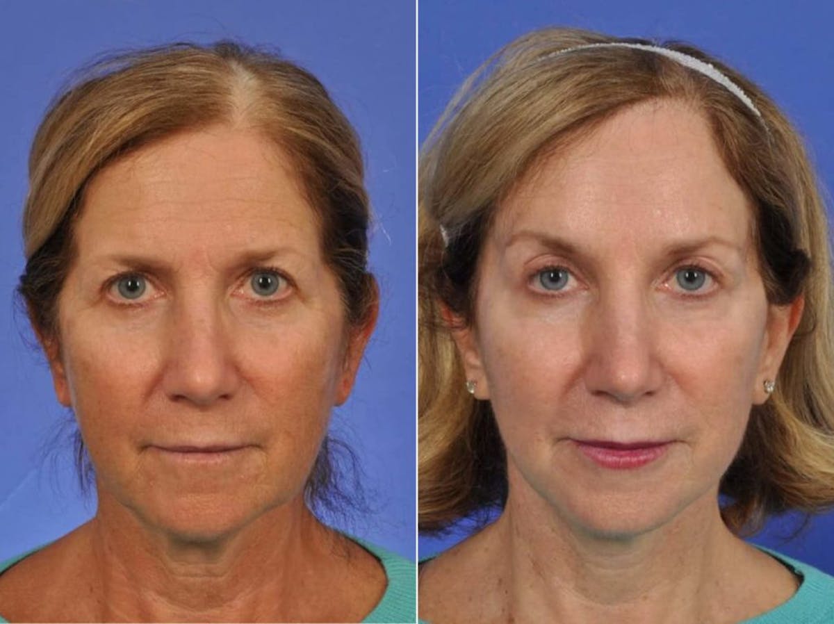 Blepharoplasty Before & After Gallery - Patient 249755 - Image 1
