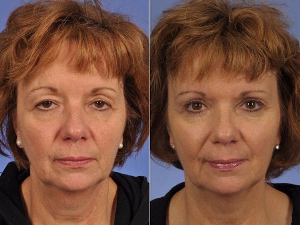 Blepharoplasty Before & After Gallery - Patient 373762 - Image 1