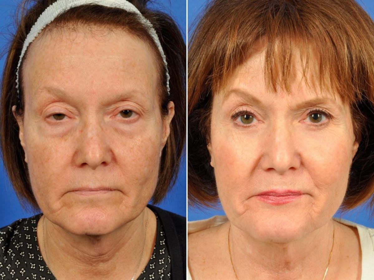 Blepharoplasty Before & After Gallery - Patient 178904 - Image 1