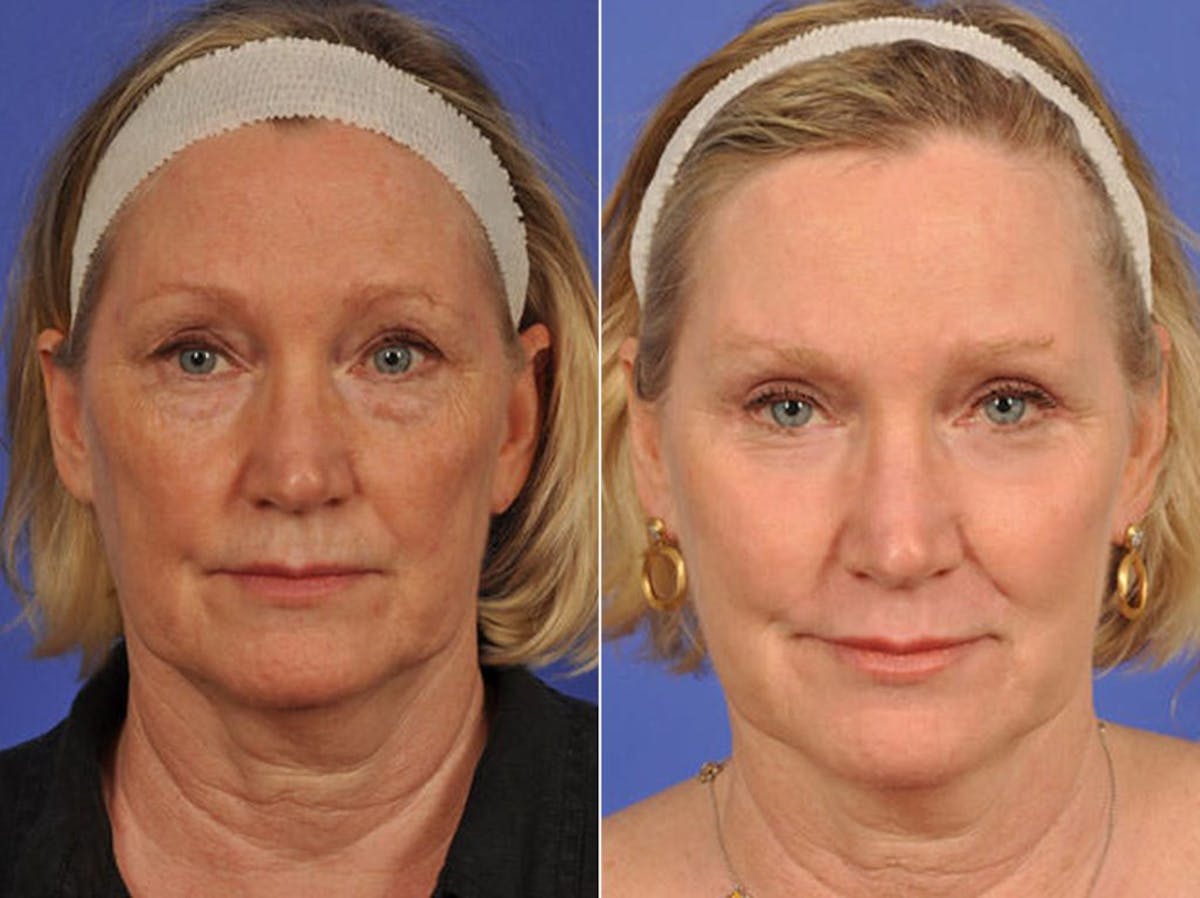 Blepharoplasty Before & After Gallery - Patient 353316 - Image 1