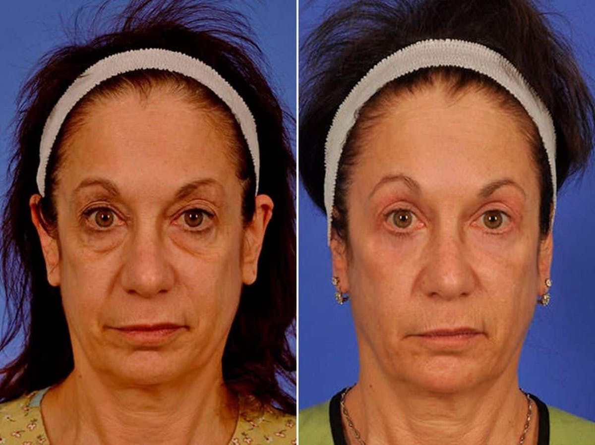 Blepharoplasty Before & After Gallery - Patient 627532 - Image 1