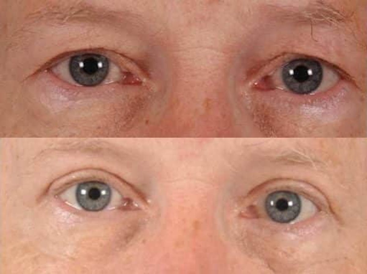 Blepharoplasty Before & After Gallery - Patient 108908 - Image 1