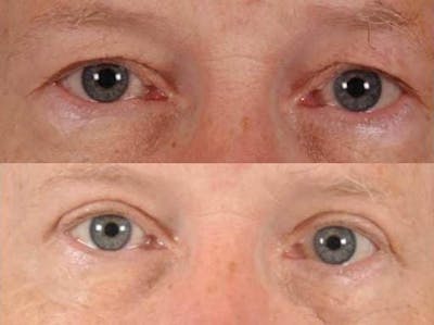 Blepharoplasty Before & After Gallery - Patient 108908 - Image 1