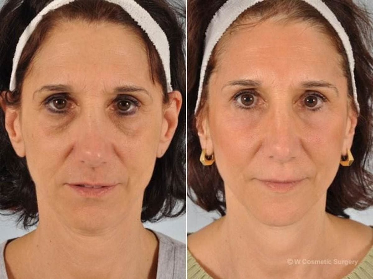 Blepharoplasty Before & After Gallery - Patient 313998 - Image 1