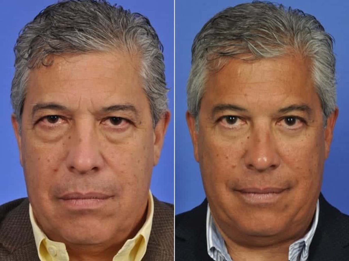 Blepharoplasty Before & After Gallery - Patient 218069 - Image 1