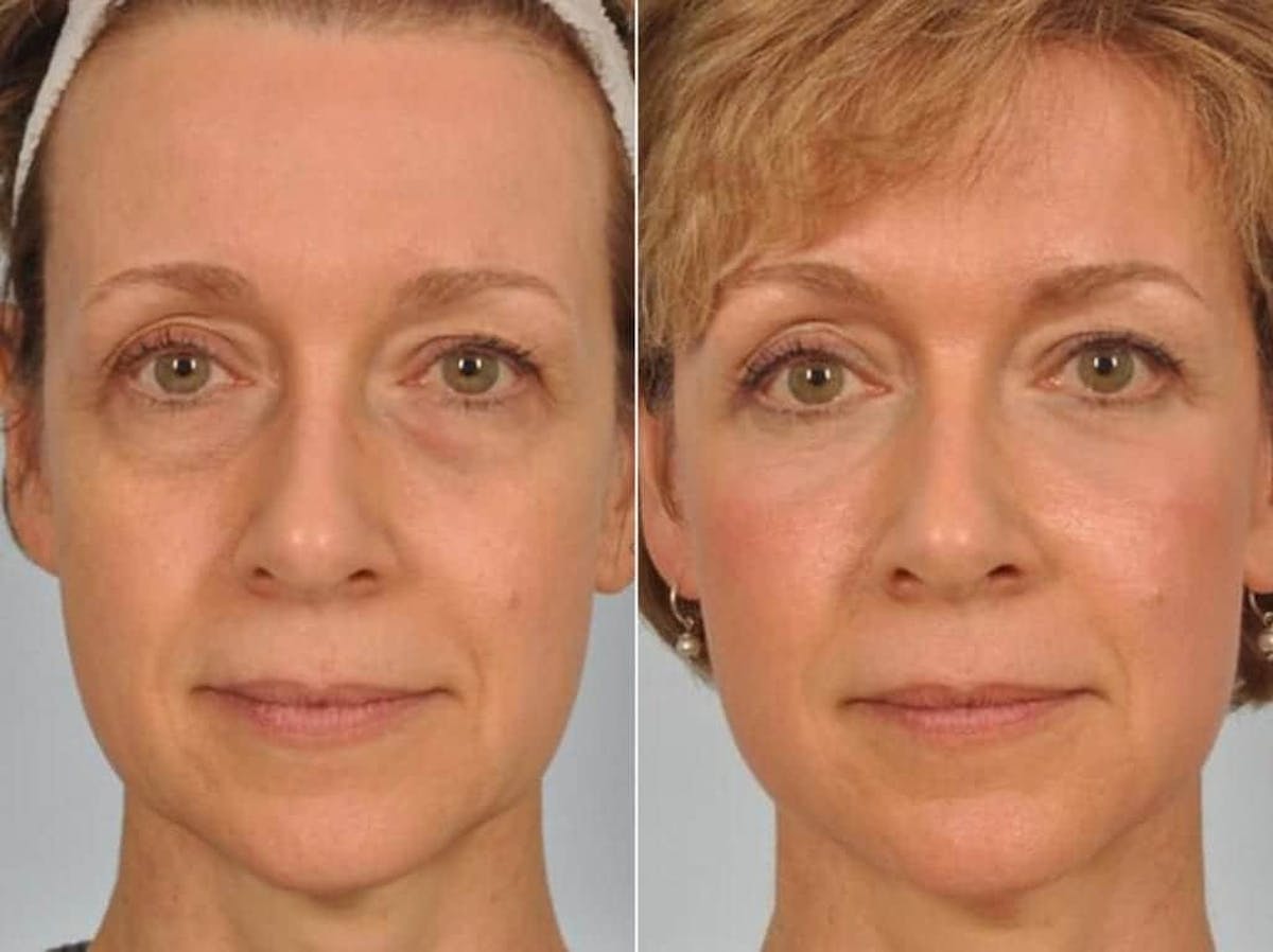 Blepharoplasty Before & After Gallery - Patient 279683 - Image 1